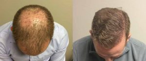 NeoGraft Hair Restoration</