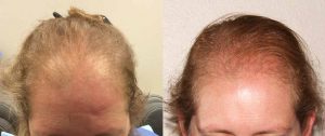 Women's Hair Loss